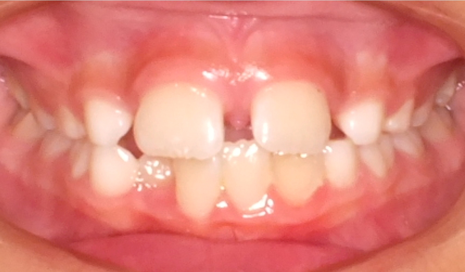 Impacted Tooth